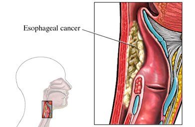 Fumonisins Fumonisins are associated with esophageal cancer